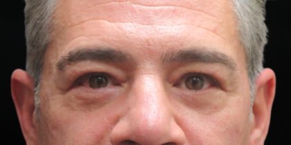 Eyelid Surgery Before & After Patient #11901