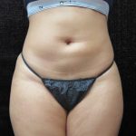 Liposuction Before & After Patient #11546