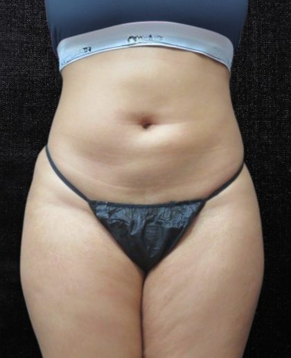 Liposuction Before & After Patient #11546