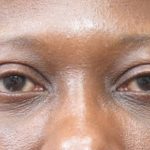 Eyelid Surgery Before & After Patient #11902