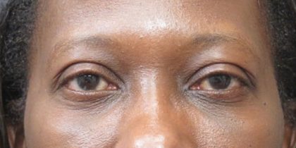 Eyelid Surgery Before & After Patient #11902