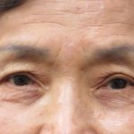 Eyelid Surgery Before & After Patient #11903