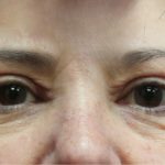 Eyelid Surgery Before & After Patient #11904
