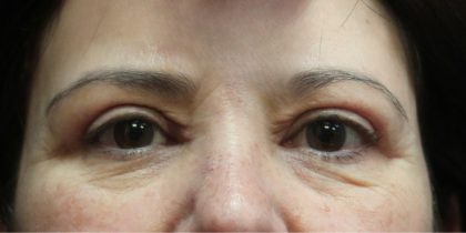 Eyelid Surgery Before & After Patient #11904