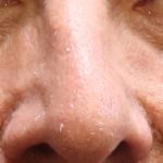 Eyelid Surgery Before & After Patient #11905