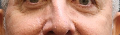 Eyelid Surgery Before & After Patient #11905