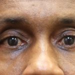 Eyelid Surgery Before & After Patient #11906