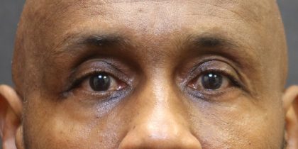 Eyelid Surgery Before & After Patient #11906