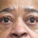 Eyelid Surgery Before & After Patient #11907