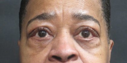 Eyelid Surgery Before & After Patient #11907