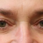 Eyelid Surgery Before & After Patient #11908
