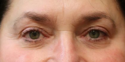 Eyelid Surgery Before & After Patient #11908