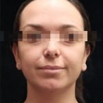Rhinoplasty Before & After Patient #11948