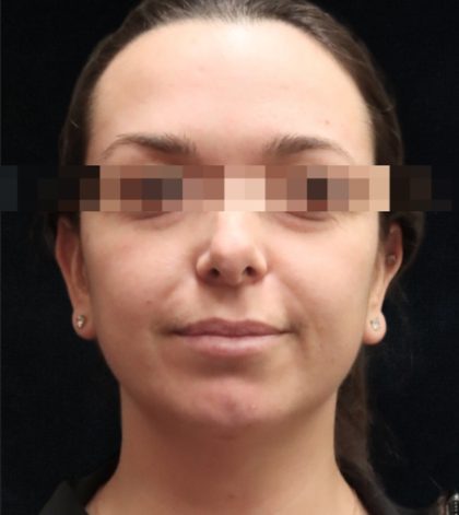 Rhinoplasty Before & After Patient #11948