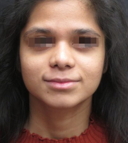 Rhinoplasty Before & After Patient #11949