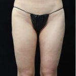 Liposuction Before & After Patient #11547