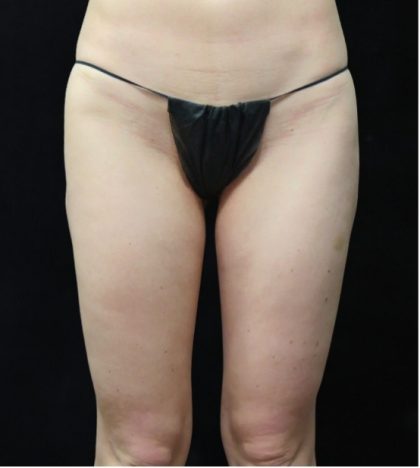 Liposuction Before & After Patient #11547
