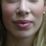 Rhinoplasty Before & After Patient #11950