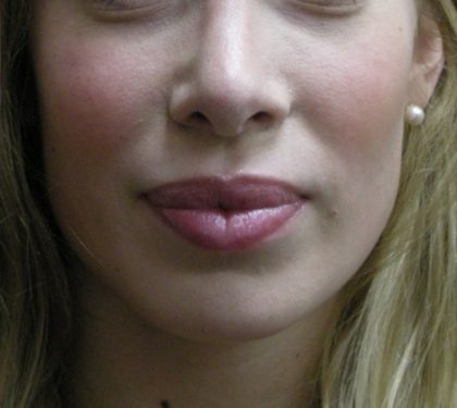 Rhinoplasty Before & After Patient #11950