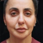 Rhinoplasty Before & After Patient #11951