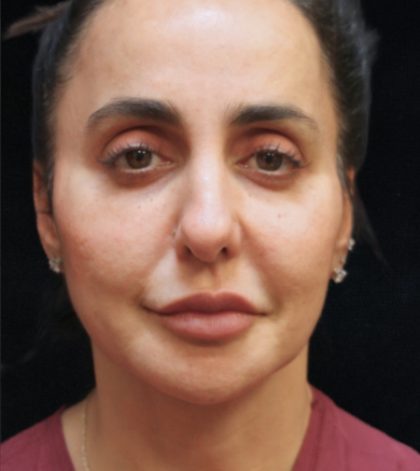 Rhinoplasty Before & After Patient #11951