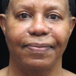 Rhinoplasty Before & After Patient #11952