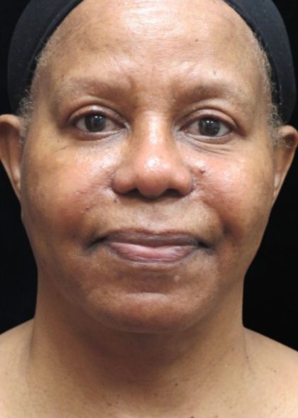 Rhinoplasty Before & After Patient #11952
