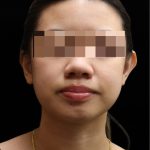 Ear Reshaping Before & After Patient #12011