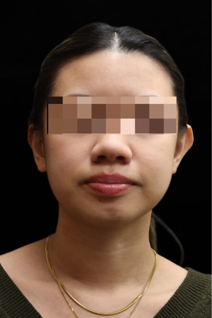 Ear Reshaping Before & After Patient #12011
