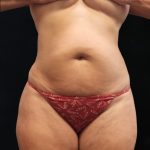 Liposuction Before & After Patient #11549