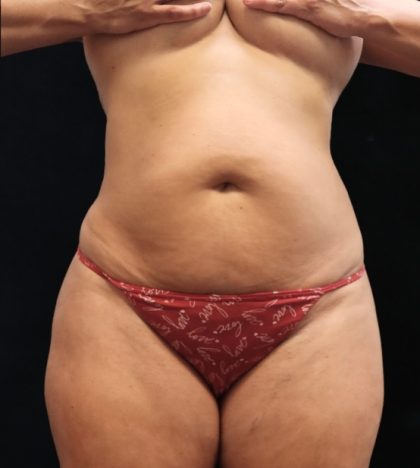 Liposuction Before & After Patient #11549