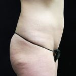Liposuction Before & After Patient #11554