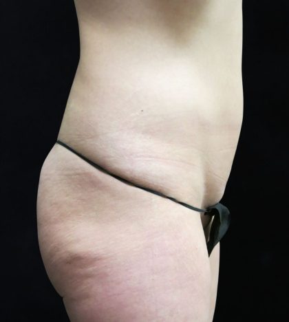 Liposuction Before & After Patient #11554