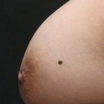 Inverted Nipple Correction Before & After Patient #11633