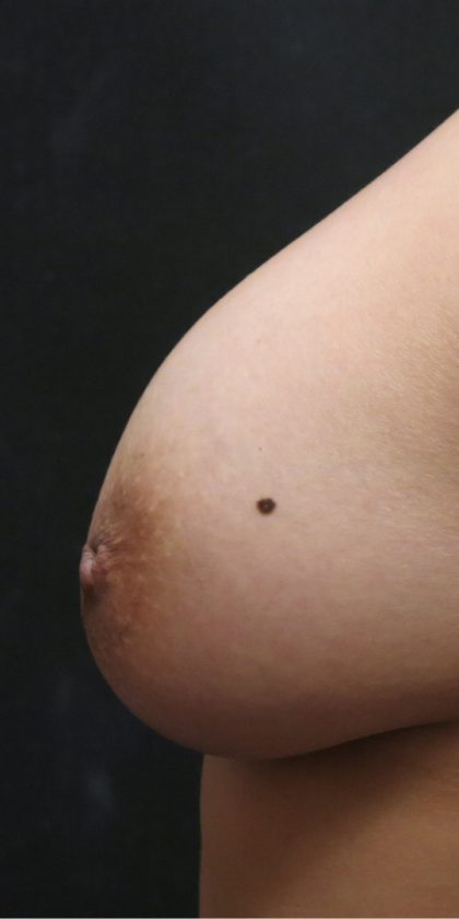 Inverted Nipple Correction Before & After Patient #11633