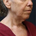 Facelift Before & After Patient #11659