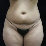 Liposuction Before & After Patient #11540