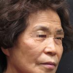 Facelift Before & After Patient #11664