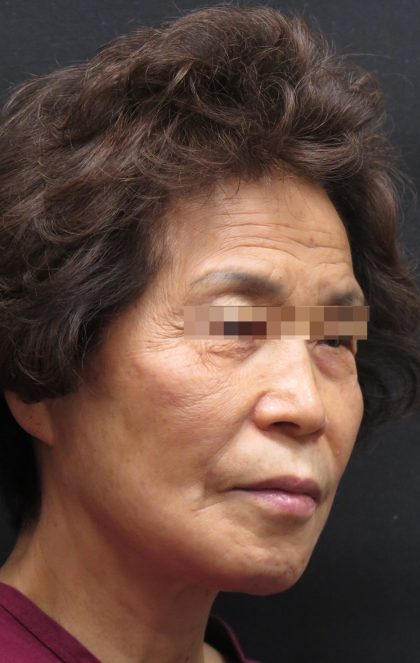 Facelift Before & After Patient #11664