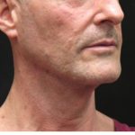 Facelift Before & After Patient #11666