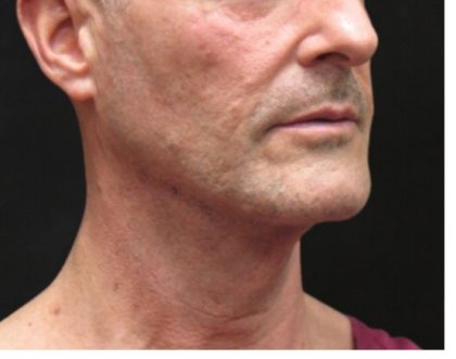 Facelift Before & After Patient #11666