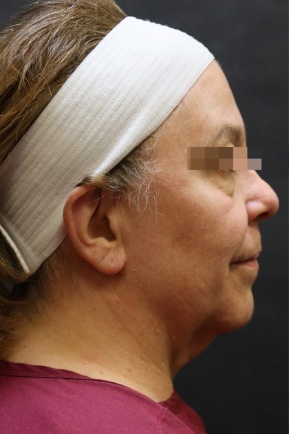 Facelift Before & After Patient #11663