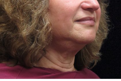Facelift Before & After Patient #11667