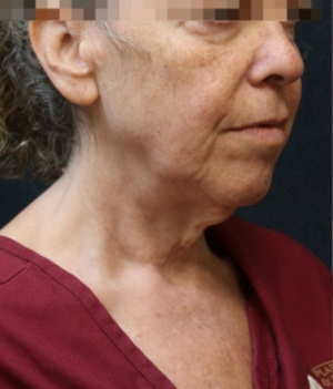 Levinelift Before & After Patient #11787