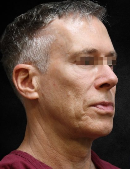 Levinelift Before & After Patient #11789