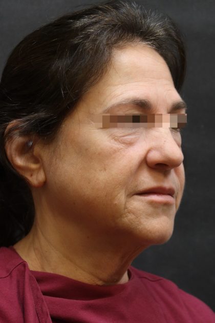 Levinelift Before & After Patient #11788
