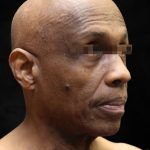 Levinelift Before & After Patient #11792