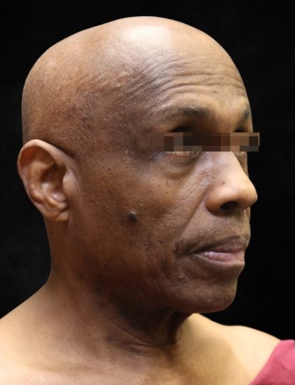 Levinelift Before & After Patient #11792