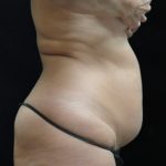 Liposuction Before & After Patient #11545