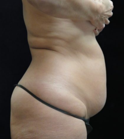 Liposuction Before & After Patient #11545